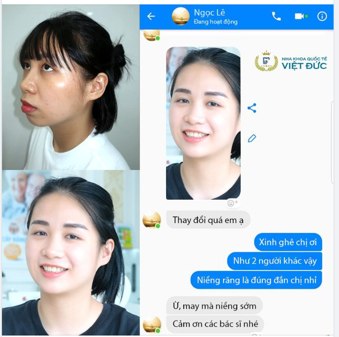 NIỀNG RĂNG XONG NHƯ HAI NGƯỜI KHÁC NHAU VẬY
