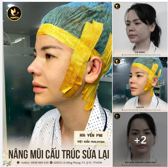Nữ Việt kiều Malaysia tranh thủ về Việt Nam NÂNG MŨI