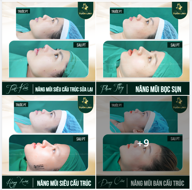 Ở ĐÂY CHÚNG TÔI CHỈ CÓ MŨI ĐẸP