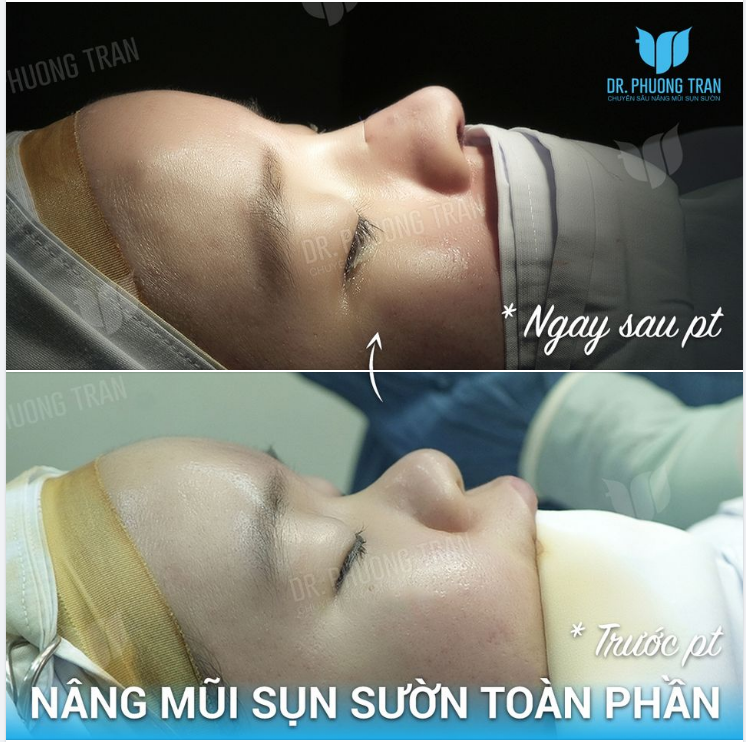 Ơ ĐỘNG ĐẤT À Không phải đấy là chiếc mũi đẹp chấn động mà thôi…!