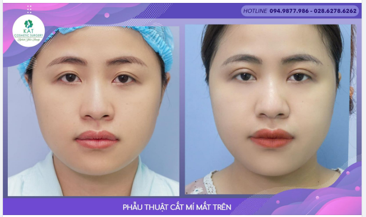 Phẫu thuật cắt mí mắt trên tại KAT đã giúp bạn tạm biệt đôi mắt không rõ nếp mí , sụp vaf buồn và trao lại cho bạn một ánh mắt to rõ hơn giúp gương mặt bạn sáng hơn và ko hề mất đi vẻ nam tính .