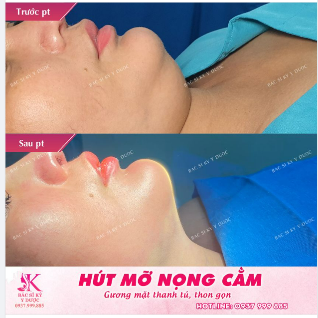 Phẫu Thuật Tạo Hình Cằm Golden V Là Gì