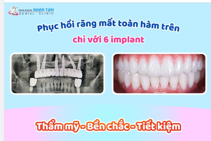 PHỤC HỒI RĂNG MẤT TOÀN HÀM TRÊN CHỈ VỚI 6 IMPLANT