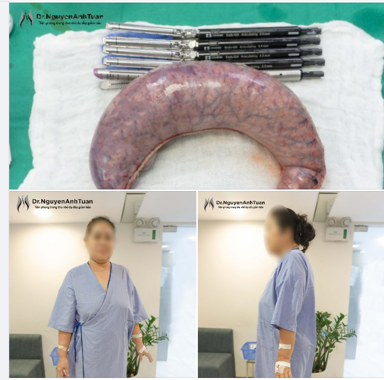 Quyết định thu nhỏ dạ dày để bước vào hành trình giảm cân sau 20 năm sống trong tình trạng cân nặng dư thừa với nhiều bệnh lý kèm theo.