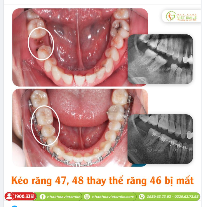 RĂNG 8 (RĂNG KHÔN) CÓ THỰC SỰ MỌC "NGU"?