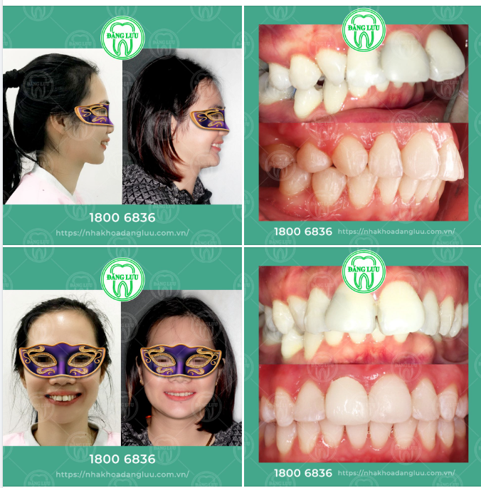 Răng hô, chìa kém thẩm mỹ