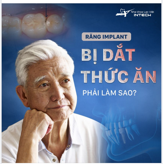 RĂNG IMPLANT BỊ DẮT THỨC ĂN PHẢI LÀM SAO?