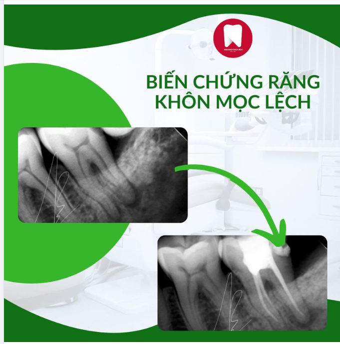 RĂNG KHÔN MỌC LỆCH KHÔNG NHỒ SỚM SẼ GÂY RA HẬU QUẢ KHÔN LƯỜNG