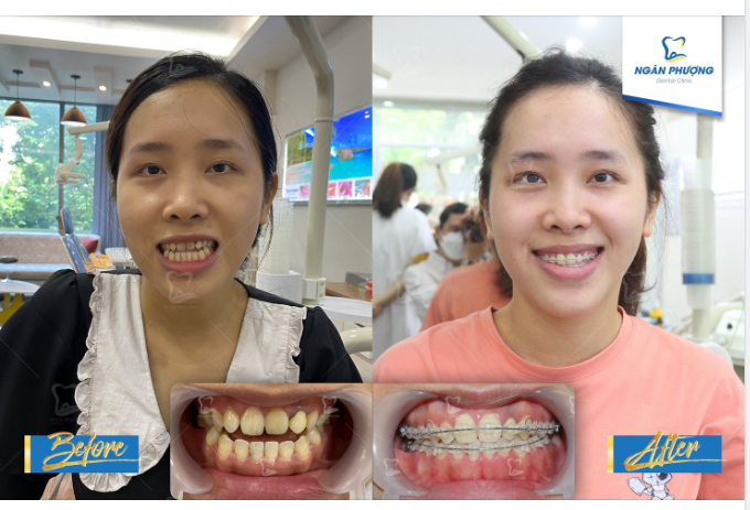 Răng móm sau 10 tháng có thể cải thiện như thế nào