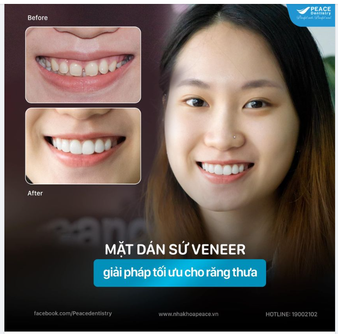 RĂNG THƯA VÀ MẶT  DÁN SỨ VENEER