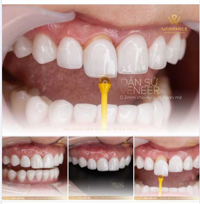 RÚT NGẮN KHOẢNG CÁCH TỚI NỤ CƯỜI HOÀN MỸ