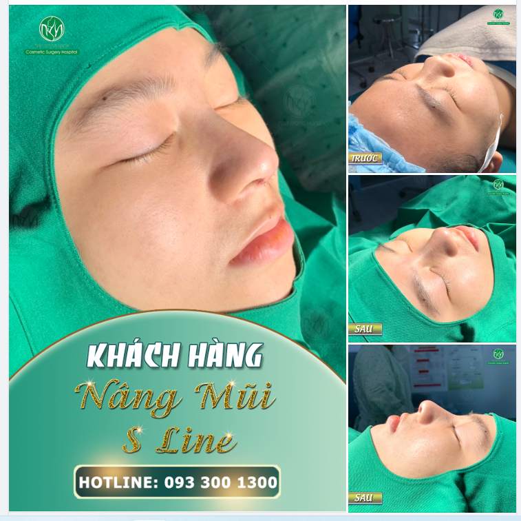 SÁNG THỨ 6 VỚI CA NÂNG MŨI S LINE
