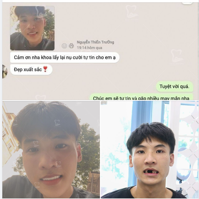 Sau 1 tuần mà bạn đã chẳng ngần ngại selfie ngay gửi nha khoa kèm lời cảm ơn chân thành nhất.