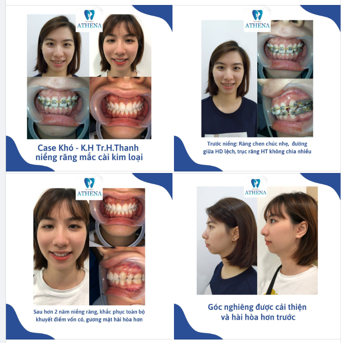 Sau khoảng 2 năm, cô gái Thanh bé nhỏ đã tìm được nụ cười hằng mơ ước của mình.