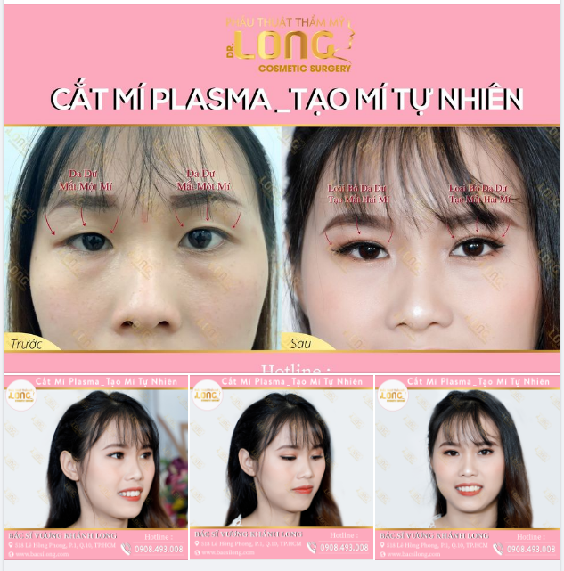 Sở hữu đôi mắt gây thương nhớ nhờ cắt mí Plasma