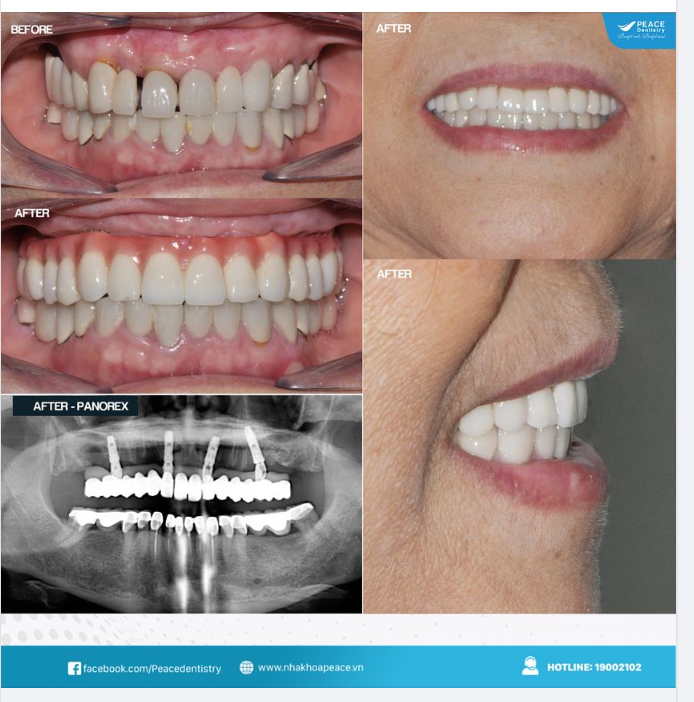 SỰ THAY THẾ HOÀN HẢO CHO HÀM THÁO LẮP VÀ CẦU RĂNG SỨ DÀI