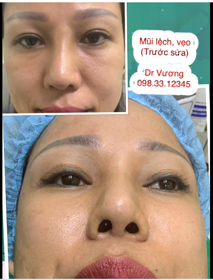 SỬA MŨI với Dr Vương