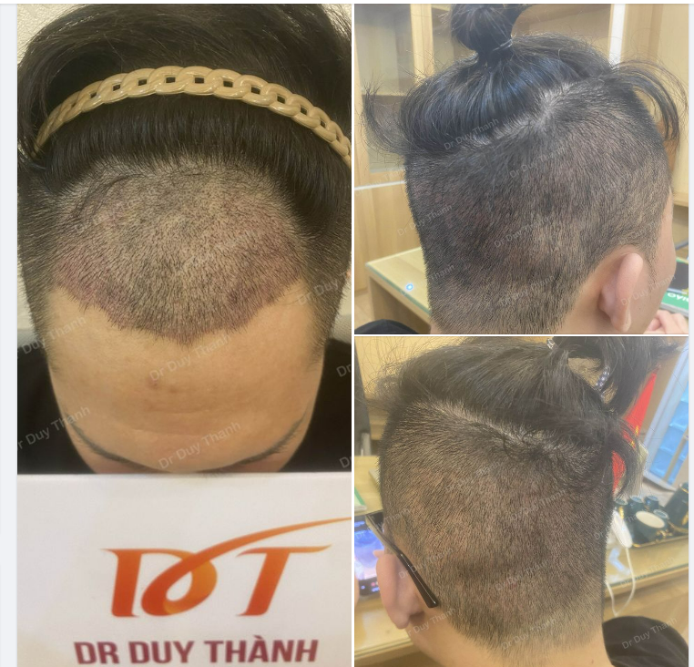 TÁI KHÁM 10 NGÀY SAU CẤY TÓC