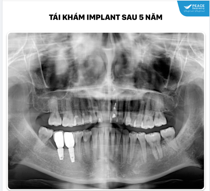 TÁI KHÁM IMPLANT SAU 5 NĂM