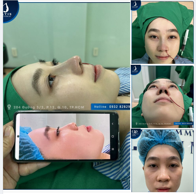 Tại sao bạn muốn nâng mũi nhưng còn chưa sẵn sàng