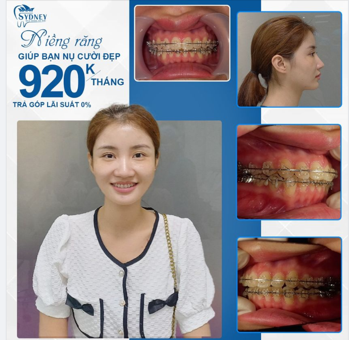 TẠI SAO NGƯỜI TRƯỞNG THÀNH VẪN PHẢI NIỀNG RĂNG CHỨ KHÔNG CHỈ TRẺ NHỎ?