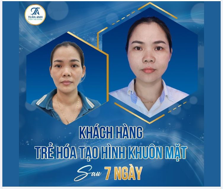 TẠI SAO trẻ hóa tạo hình khuôn mặt bằng mỡ tự thân tại Thẩm Mỹ Tuấn Anh lại được nhiều khách hàng lựa chọn