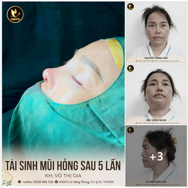 TÁI SINH MŨI HỎNG SAU 5 LẦN TÌM LẠI NIỀM TIN CHO CHỊ VÕ THỊ GIA
