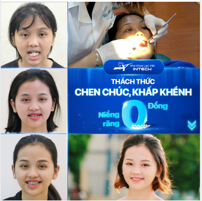 Tạm biệt Hô  -  Móm ​​​​​​​ -  Khấp khểnh nhờ cá nhân hóa mắc cài với X-Matrix