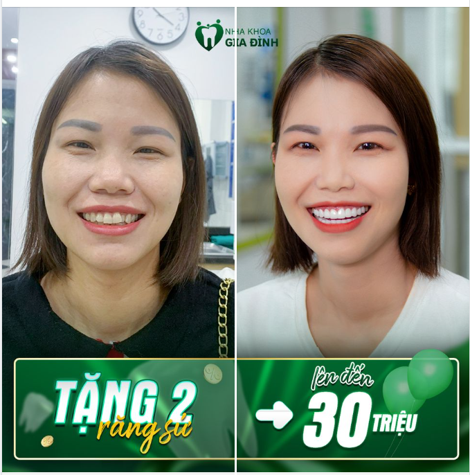 TẶNG NGAY 2 RĂNG SỨ CAO CẤP LÊN TỚI 30.000.000