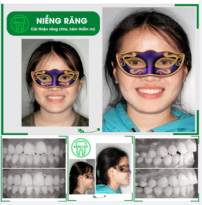 Tăng thẩm mỹ nụ cười & mang đến một sức khỏe răng miệng lành mạnh