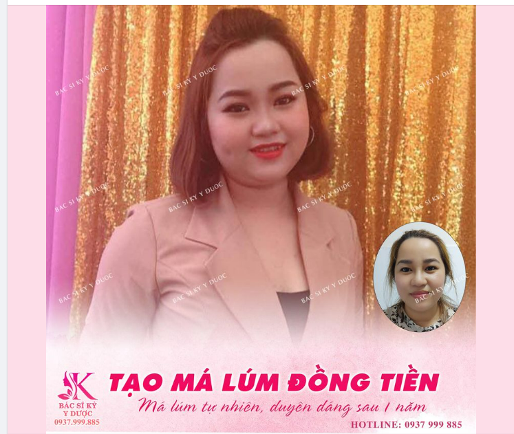 Tạo má lúm đồng tiền - Cho nụ cười thêm duyên
