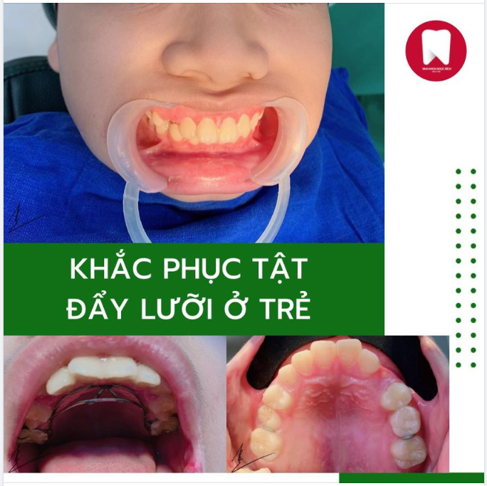TẬT ĐẨY LƯỠI Ở TRẺ - ĐIỀU TRỊ SỚM CÀNG CÓ LỢI