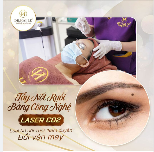 Tẩy nốt ruồi Laser CO2 - Tạm biệt nốt ruồi kém xinh