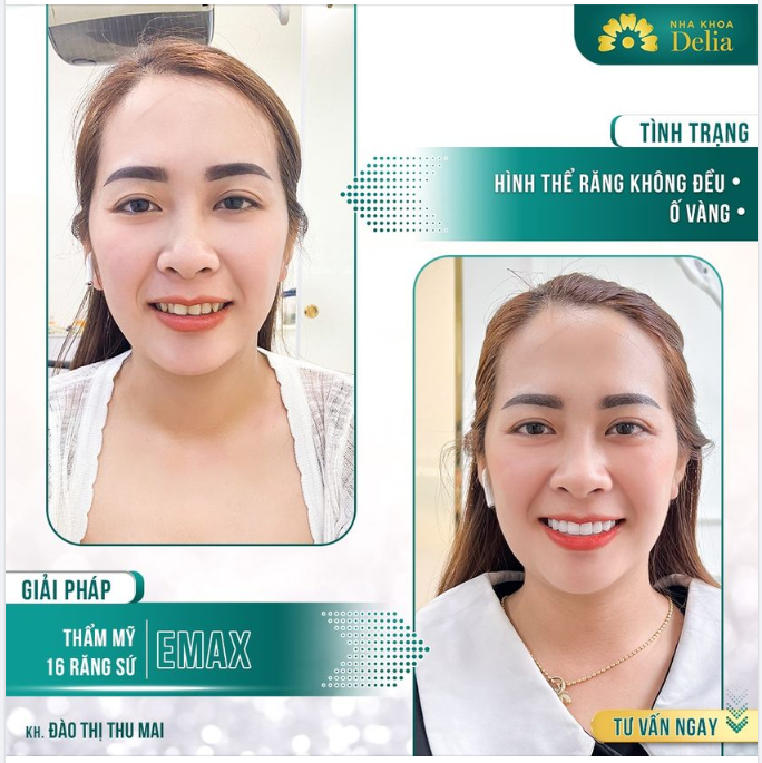 Thẩm mỹ 16 răng sứ Emax - Khắc phục mọi tình trạng răng