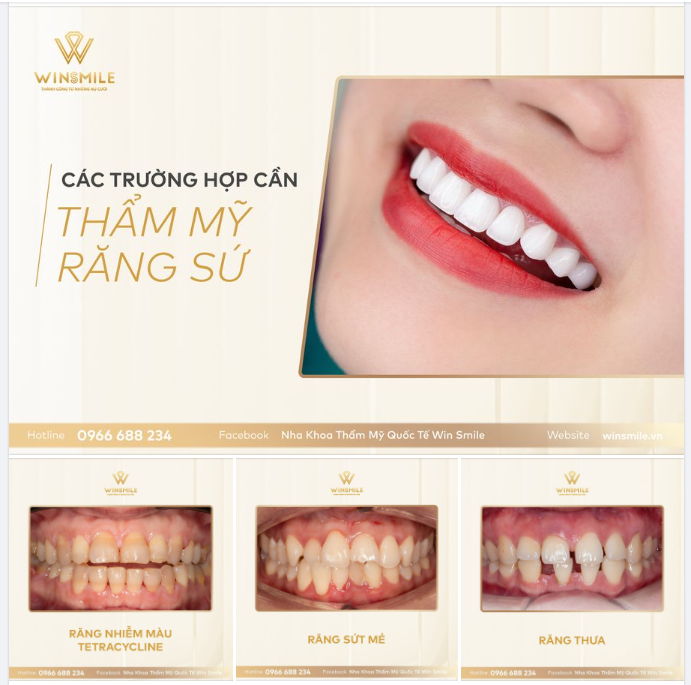 THẨM MỸ RĂNG SỨ - PHÉP MÀU NHIỆM CHO KHUYẾT ĐIỂM VỀ RĂNG