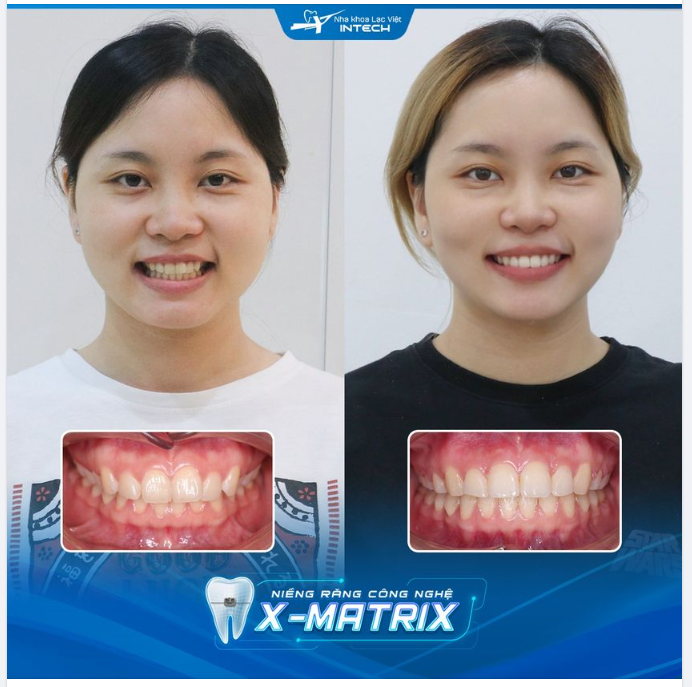 THÁO MẮC CÀI SỚM 5 THÁNG SO VỚI DỰ KIẾN NHỜ NIỀNG RĂNG X-MATRIX