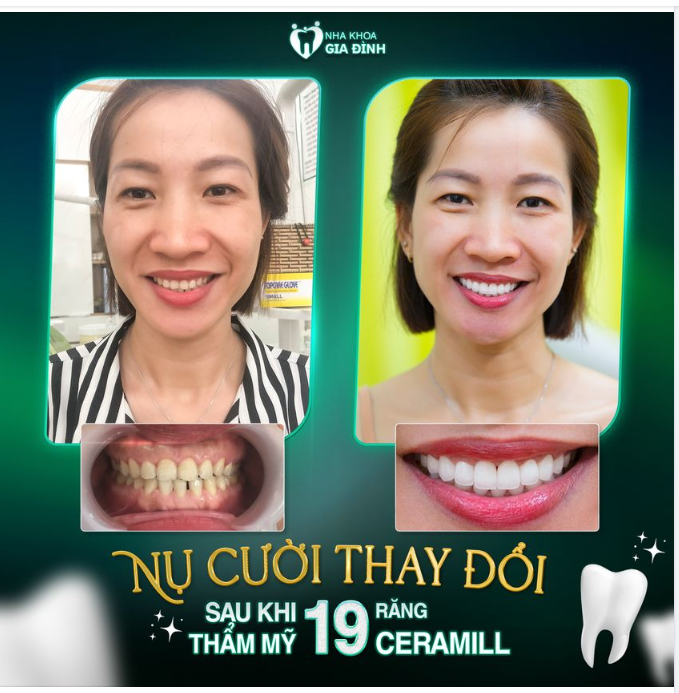 ​​​​​​​THAY ĐỔI HÀM RĂNG – THAY ĐỔI NHAN SẮC