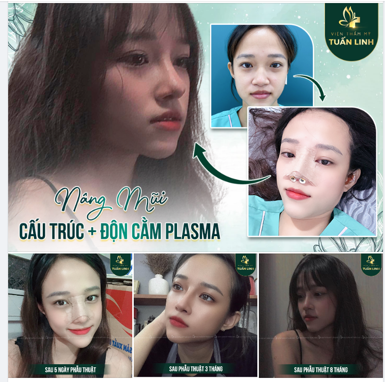 THAY ĐỔI NGOẠN MỤC VỚI COMBO NÂNG MŨI CẤU TRÚC + ĐỘN CẰM PLASMA