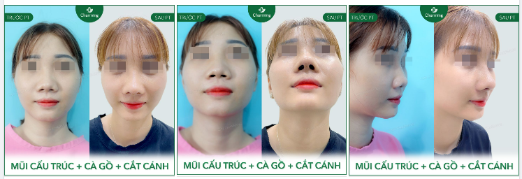 Thay đổi toàn diện cho một chiếc mũi không chỉ cần mỗi phẫu thuật nâng mũi, đôi khi cũng cần kết hợp cả cà gồ, cắt cánh, thu chóp, cắt xương nền mũi,…thì mới đạt được độ hoàn thiện.