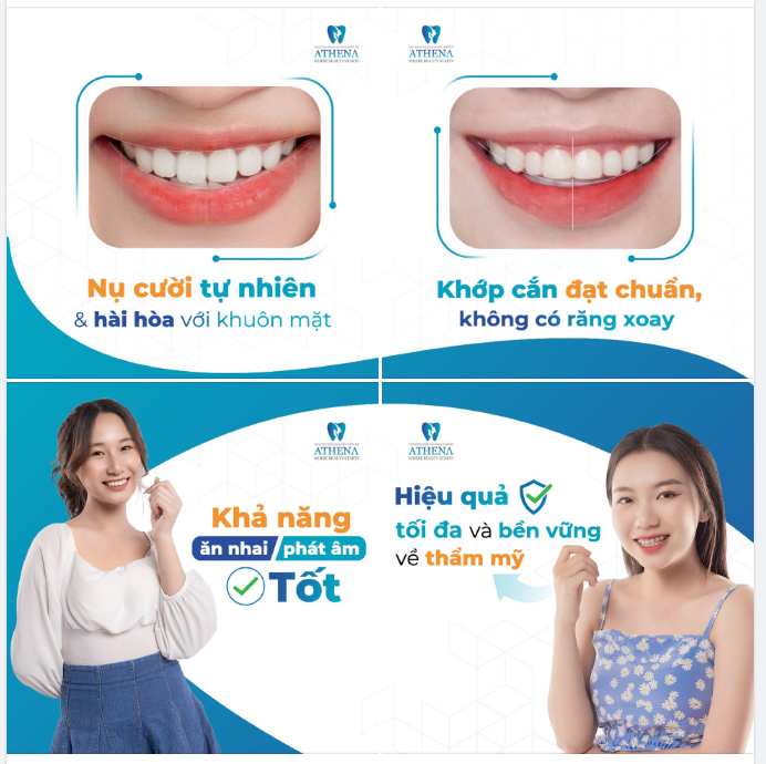 THẾ NÀO LÀ CA NIỀNG RĂNG THÀNH CÔNG?