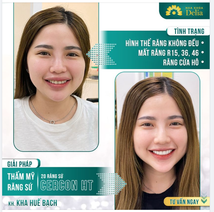 Thêm 1 ca răng sứ đẹp xuất sắc được kiến tạo từ chính đôi bàn tay của bác sĩ Delia.