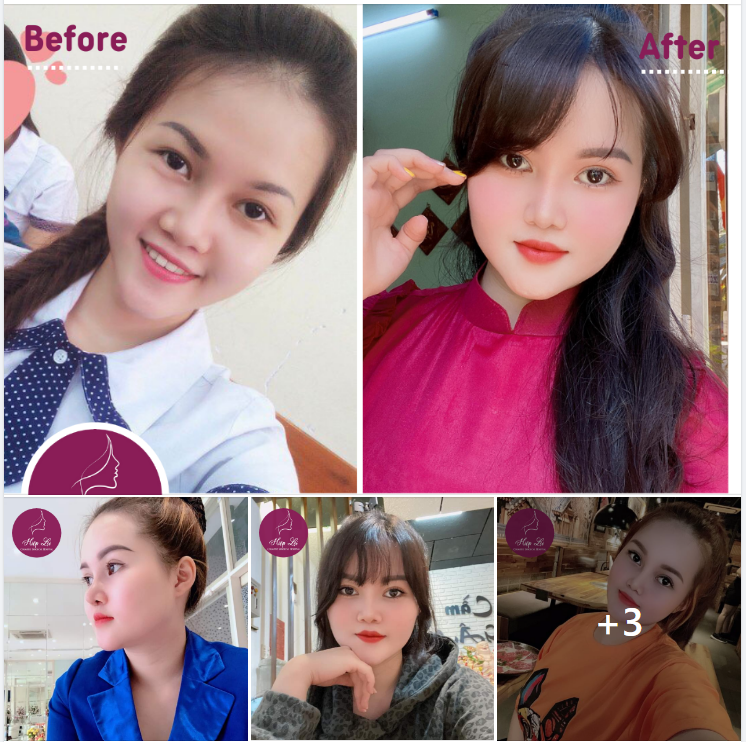 THÊM 1 COMBO MẮT ĐẸP - MŨI XINH, TỰ TIN KHOE SẮC