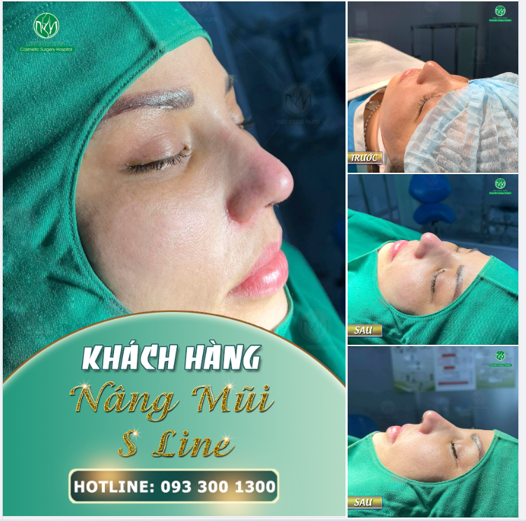 THÊM MỘT CA NÂNG MŨI S LINE NỮA HOÀN THÀNH