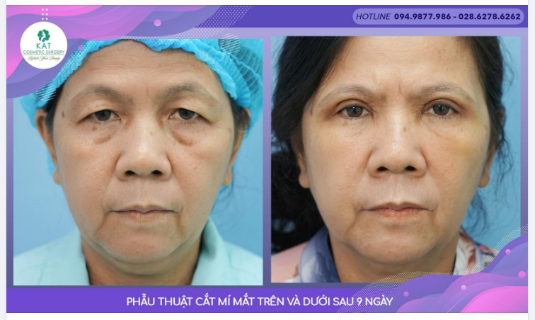 Theo Hiệp hội lão khoa thế giới, ở độ tuổi 40 bắt đầu có những dấu hiệu lão hóa và mắt là nơi chịu nhiều “thiệt thòi” nhất.