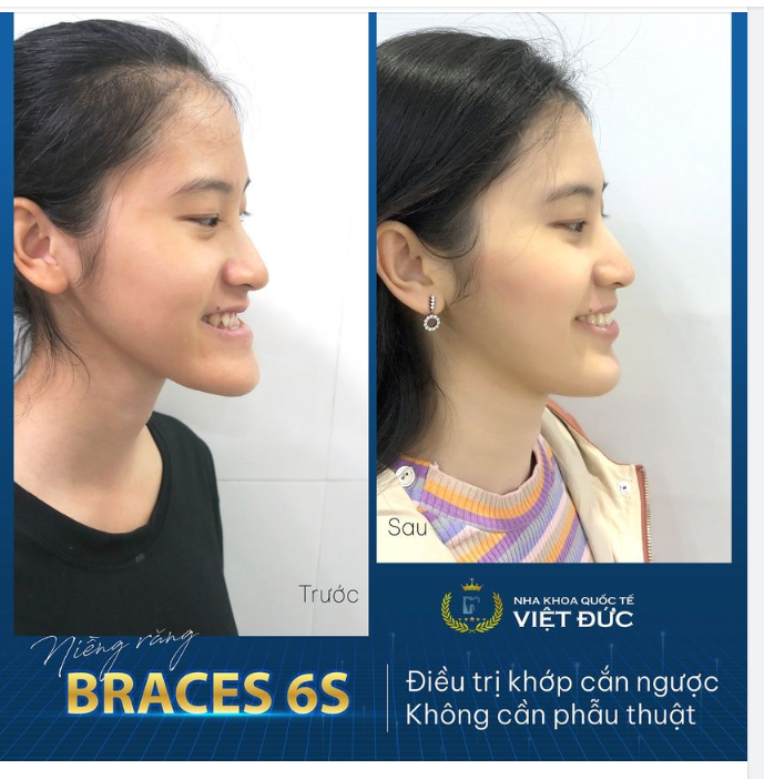 Thiết kế nụ cười chuẩn thẩm mỹ, phù hợp từng khuôn mặt