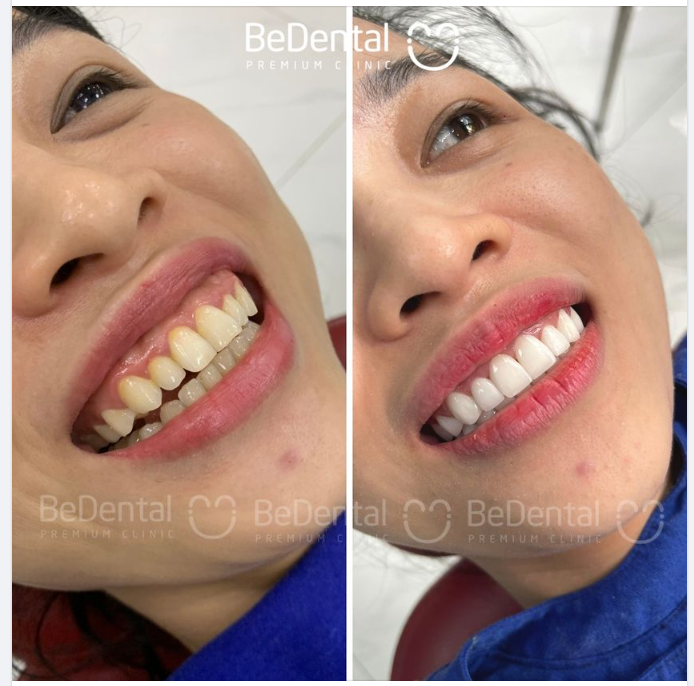 Thoát cười hở lợi, răng trắng đều hình thể cân đối