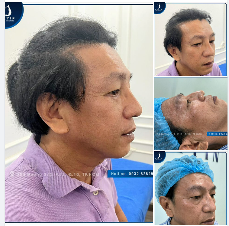 Thu nền mũi, khắc phục tình trạng mũi gồ thành công cho khách hàng nam tại Latin