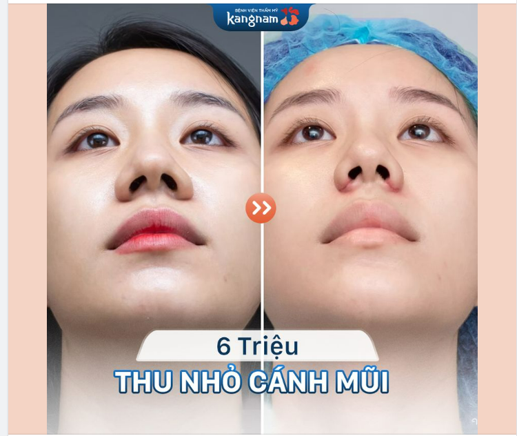 Thu nhỏ cánh mũi - Giải pháp tạo nên chiếc mũi thon gọn, hài hòa, cân đối