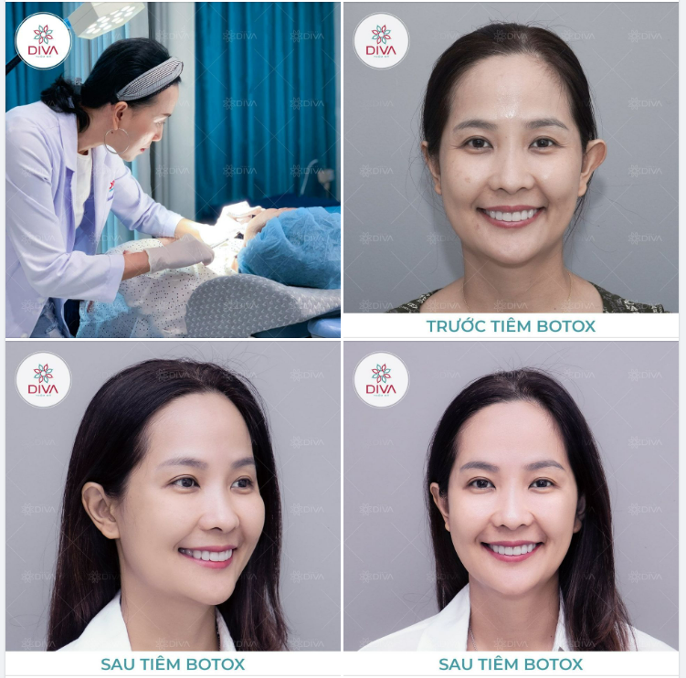 TIÊM BOTOX XONG CÓ ĐẸP NGAY KHÔNG