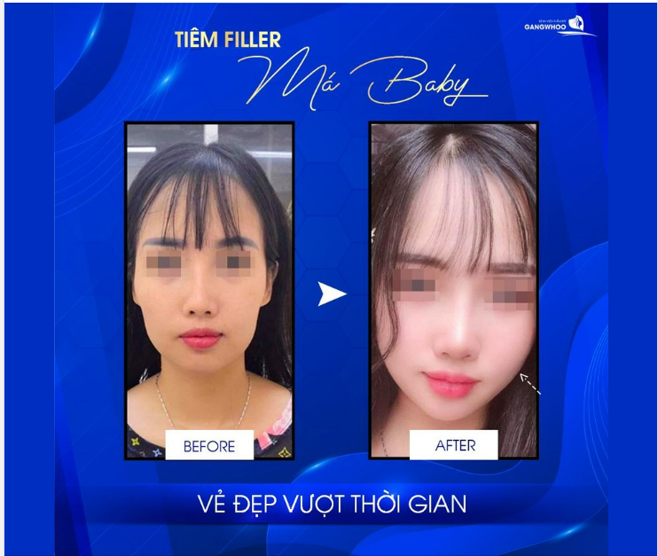 TIÊM FILLER MÁ BABY VẺ ĐẸP VƯỢT THỜI GIAN